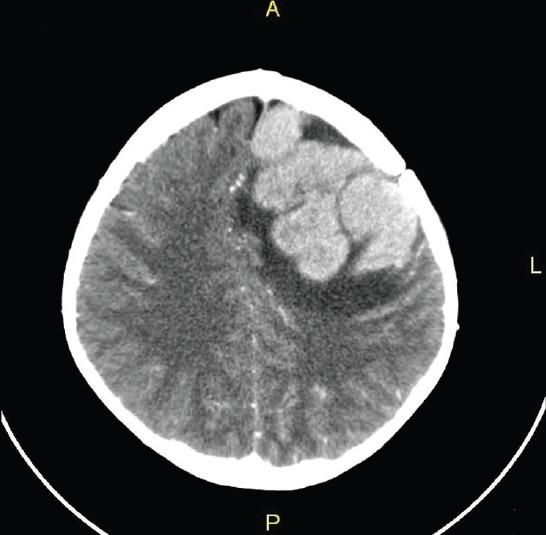 Children With Acute Lymphoblastic Leukemia Can Skip Radiation To The 